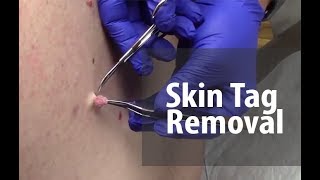 Skin Tag Removal  Dr Derm [upl. by Bena]