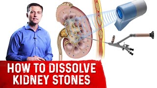 How To Dissolve Kidney Stones Explained By DrBerg [upl. by Rosabelle]