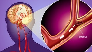 Stroke Prevention amp Transient Ischemic Attack TIA [upl. by Enelyt]