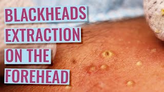 Amilios’s Blackheads Extraction on The Forehead  4th treatment part 1 [upl. by Robbert406]