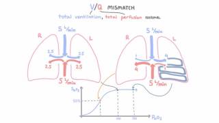 VQ mismatch [upl. by Selemas]