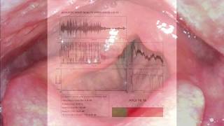 INJECTION LARYNGOPLASTY  RIGHT VOCAL FOLD PALSY [upl. by Enyrehtak453]