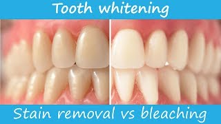 Defining teeth whitening  stain removal vs bleaching [upl. by Lednor]