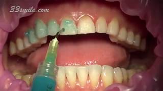 Prepless Veneers Permanent Teeth Whitening [upl. by Sirahc]