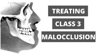 Management of Class 3 Malocclusion Orthodontics [upl. by Lemay]