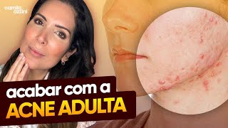 Faça isso para ACABAR com a ACNE ADULTA [upl. by Htebazileyram]