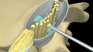 Doclan Traumatología  Anestesia raquídea [upl. by Retsev]