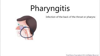 Viral pharyngitis [upl. by Gussman354]