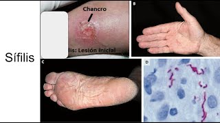 Sífilis Etapas de la infección diagnóstico y tratamiento [upl. by Eineeuq]