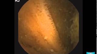 Small Bowel Tumor Detection in Capsule Endoscopy [upl. by Enirehtahc606]