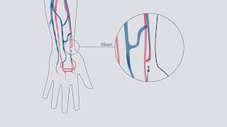 Understanding hemodialysis [upl. by Cogen162]