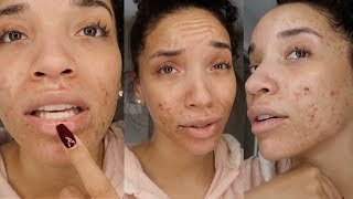 My Accutane Experience  First Week  Acne Update 3 [upl. by Neyuq]