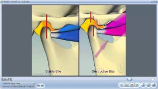 TMJ Disorders [upl. by Libys]