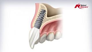 Angulated Screw Channel ASC Abutment [upl. by Enitsenrae]