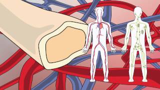 Video 20 Waldenstroms Macroglobulinemia [upl. by Analak]