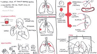 Lung Cancer  Overview [upl. by Etta507]