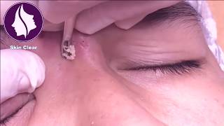 Blackheads Removal On Forehead  Get rid of Pimples  16 [upl. by Nally]