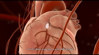 Percutaneous Coronary Intervention PCI [upl. by Onaivatco]