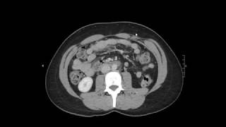 Normal CT AbdomenPelvis [upl. by Kaja82]