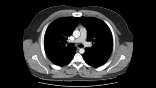 Anatomy of CT scans Thoracic cavity [upl. by Rhines]