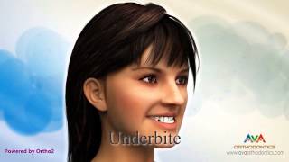 Malocclusion  Different Types [upl. by Alexandria754]