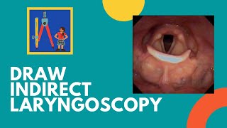 Draw Indirect Laryngoscopy Findings [upl. by Aneetsirk]