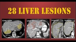 ct liver lesions [upl. by Haeluj]