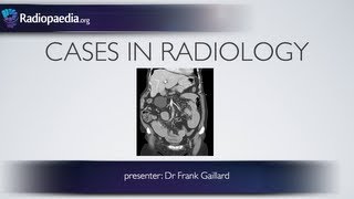 CT Scan of Chest Abdomen Pelvis [upl. by Lange]