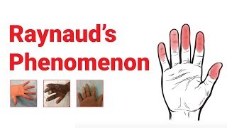 Raynaud’s Phenomenon  What You Should Know  Johns Hopkins Medicine [upl. by Luo]