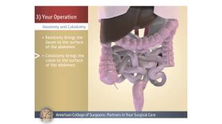 ColostomyIleostomy Your Operation [upl. by Munshi]