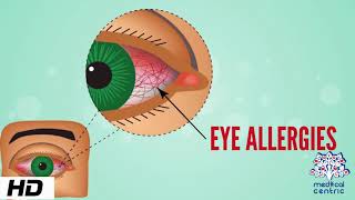 Eye Allergy Causes Signs and Symptoms Diagnosis and Treatment [upl. by Arlee736]