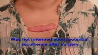 Chest Keloids  Mistakes to Avoid [upl. by Dugas]