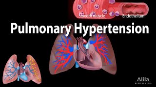 Pulmonary Hypertension Animation [upl. by Woolley]