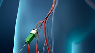 Coronary Angioplasty Femoral Access [upl. by Kingsley]