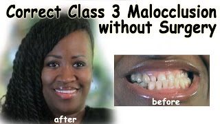 Correct Class 3 Malocclusion without Surgery  Bergen County NJ Dentist [upl. by Noswal]