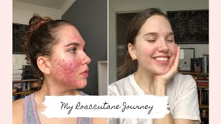 Roaccutane  My 6 Month Journey to Clear Skin [upl. by Drolet999]