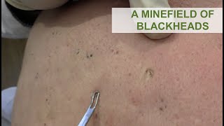 A Minefield of Blackheads  Dr Derm [upl. by Ytram]