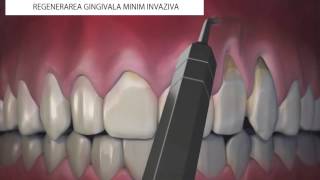 Regenerare gingivala minim invaziva [upl. by Adigun]