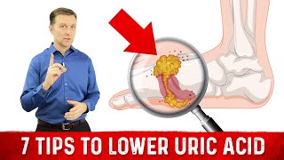 7 Tips to Lower Uric Acid – Dr Berg [upl. by Emirej]