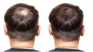 6 Foods That Can Block DHT and Fight Hair Loss [upl. by Yralam]