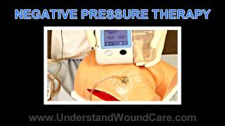 Negative Pressure Therapy Part 1 of 4 Understand Wound Care [upl. by Phillipe]