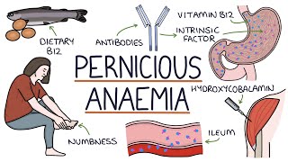 Understanding Pernicious Anaemia B12 Deficiency [upl. by Selby]