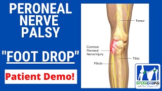 Peroneal Nerve Palsy with Foot Drop [upl. by Hasan]