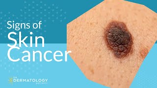 Skin Cancer Screening  Symptoms Types amp Warning Signs [upl. by Stauffer282]