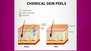 Chemical Peel Purpose amp Types [upl. by Simeon220]