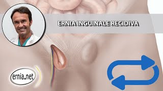 EPIGASTRIC HERNIA SURGERY amp RECOVERY [upl. by Ahsiuqal975]