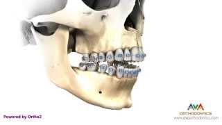 Surgical Orthodontic Treatment for Openbite  Maxillary Impaction [upl. by Alrep]