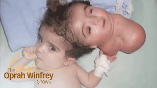 The 2Headed Baby Miracle  The Oprah Winfrey Show  Oprah Winfrey Network [upl. by Leur]