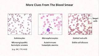 Anemia Lesson 4  Clues from the blood smear [upl. by Ijneb]