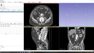 3D Slicer Tutorial 2 Manual segmentation Thresholding [upl. by Knowlton]